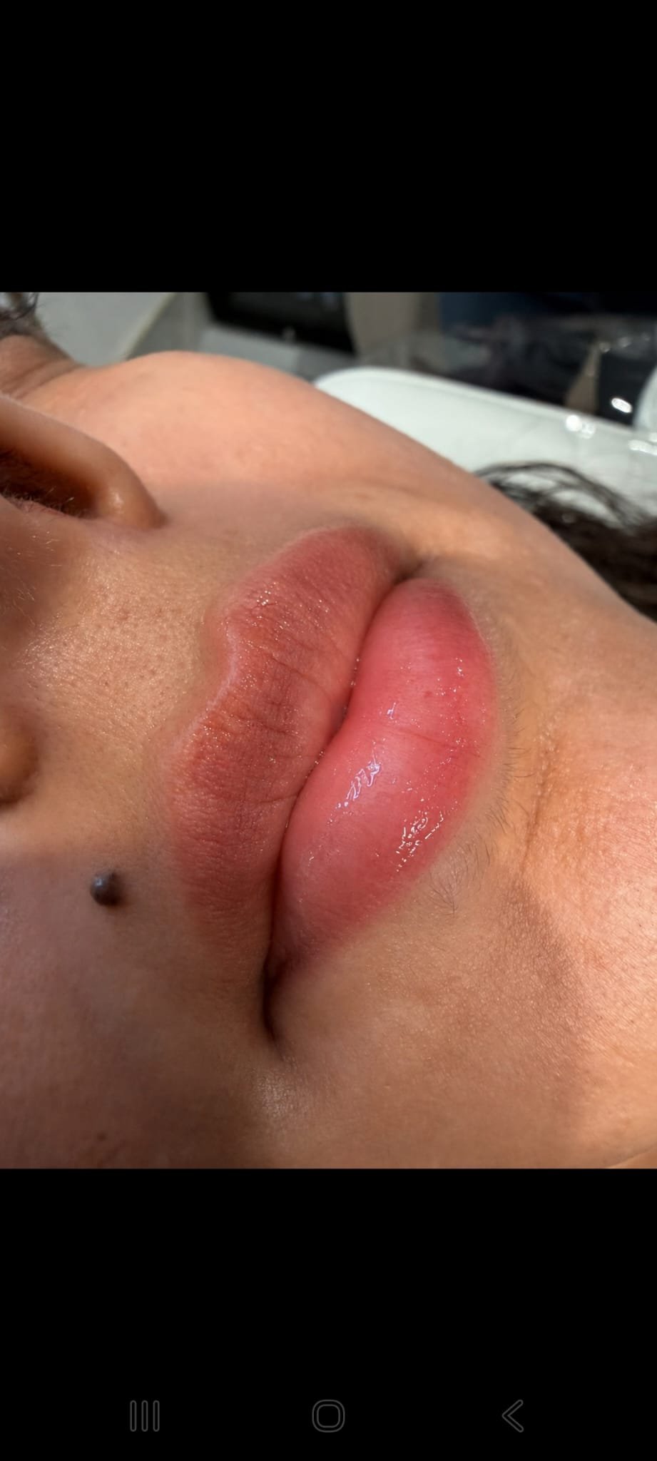 Lip Fillers